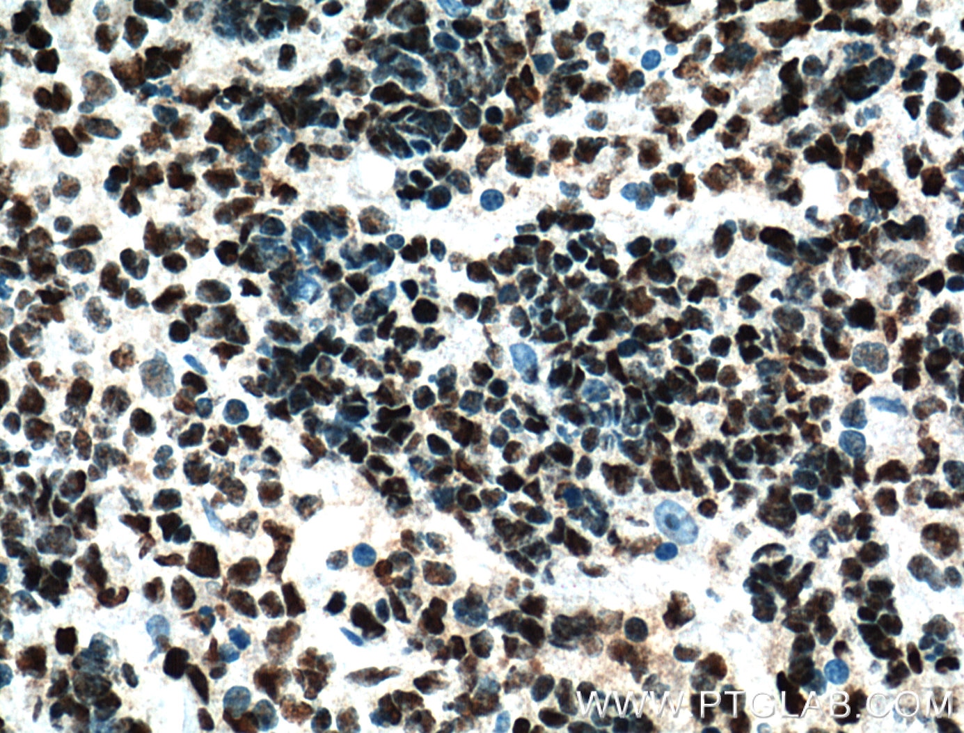 Immunohistochemistry (IHC) staining of human lymphoma tissue using HDAC1 Monoclonal antibody (66085-1-Ig)