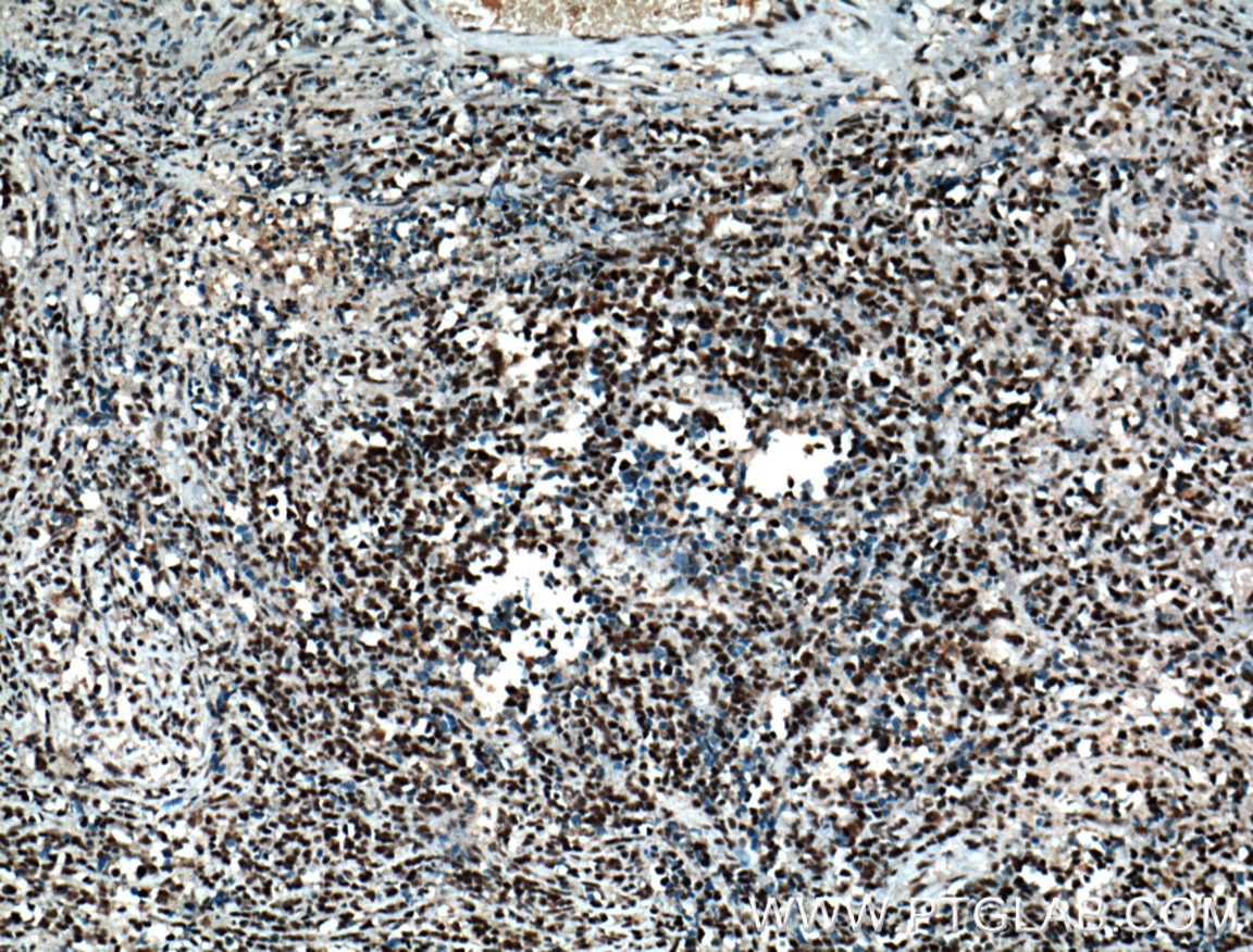 Immunohistochemistry (IHC) staining of human lymphoma tissue using HDAC1 Monoclonal antibody (66085-1-Ig)