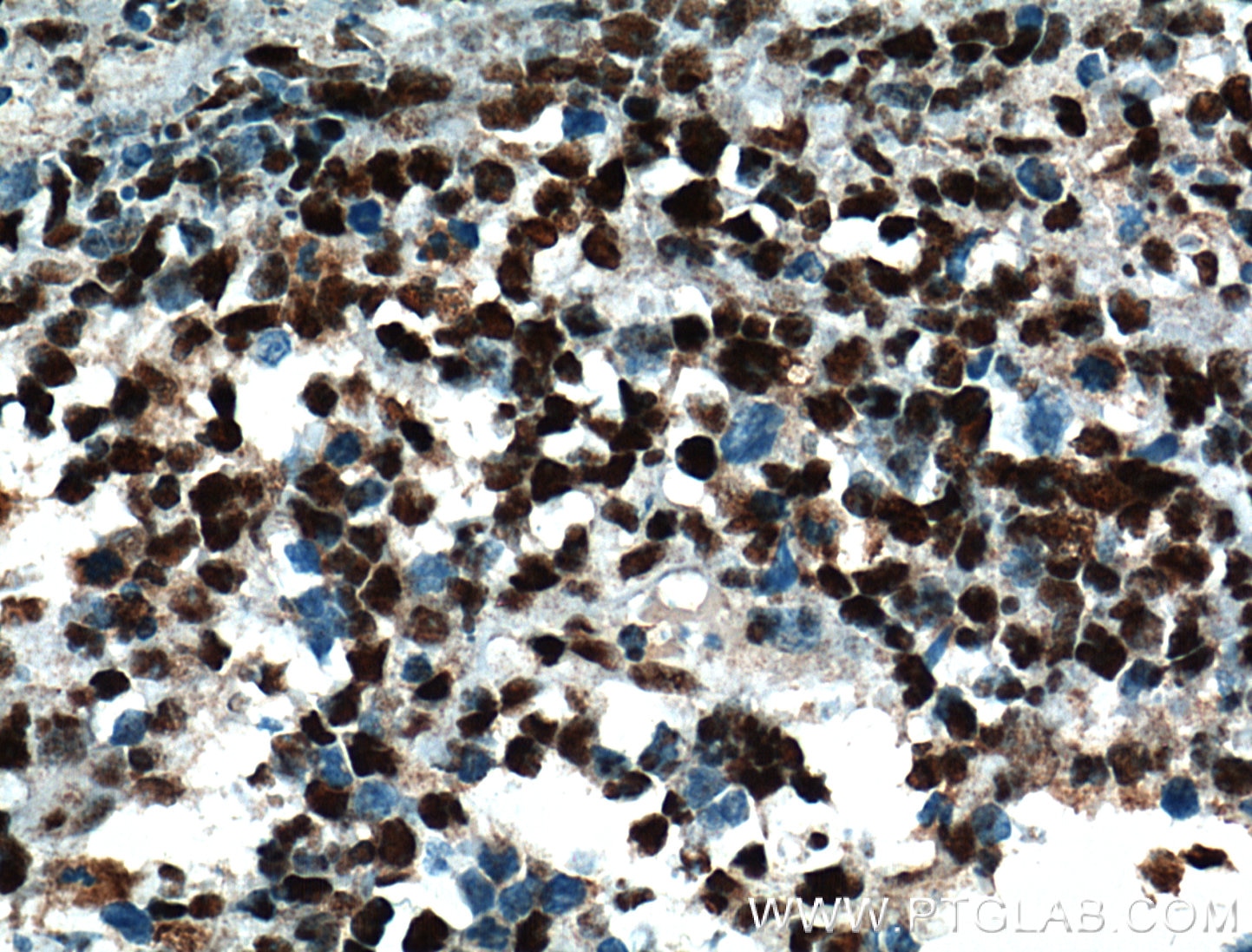 Immunohistochemistry (IHC) staining of human lymphoma tissue using HDAC1 Monoclonal antibody (66085-1-Ig)