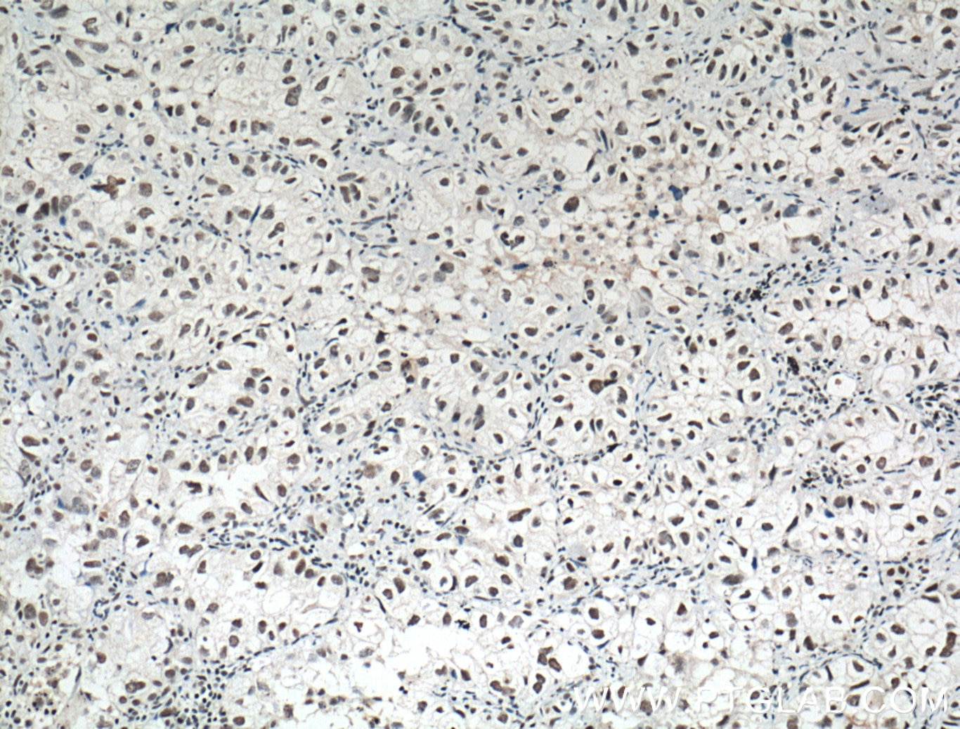 Immunohistochemistry (IHC) staining of human lung cancer tissue using HDAC1 Monoclonal antibody (66085-1-Ig)