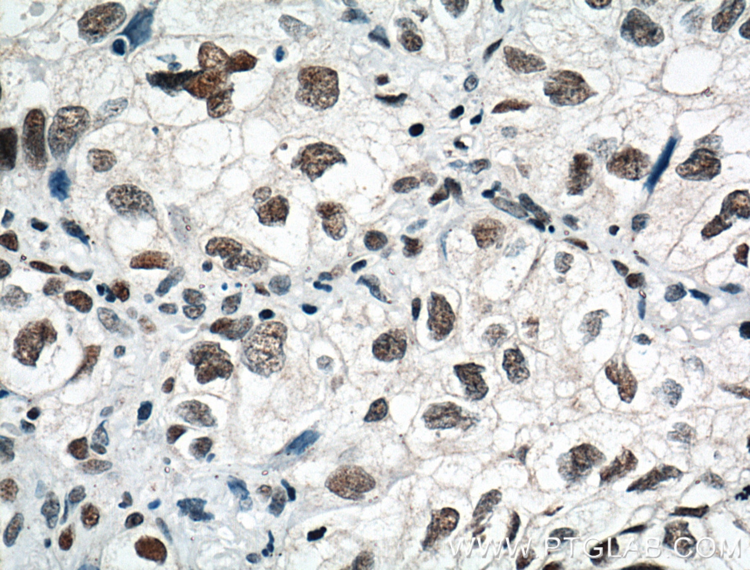 Immunohistochemistry (IHC) staining of human lung cancer tissue using HDAC1 Monoclonal antibody (66085-1-Ig)