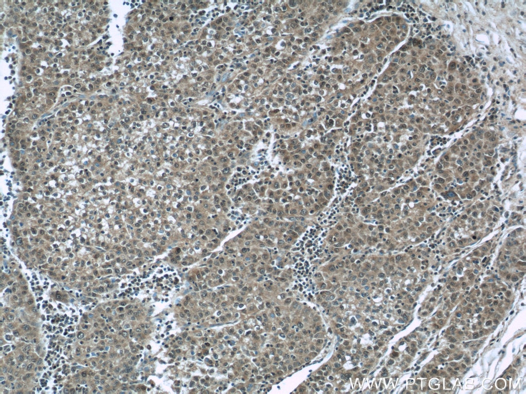 Immunohistochemistry (IHC) staining of human liver cancer tissue using HDAC10 Polyclonal antibody (24913-1-AP)