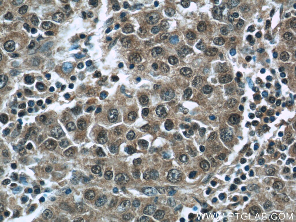 Immunohistochemistry (IHC) staining of human liver cancer tissue using HDAC10 Polyclonal antibody (24913-1-AP)