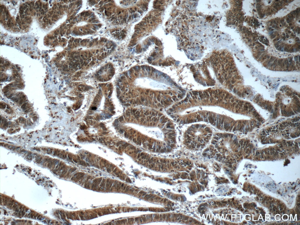 Immunohistochemistry (IHC) staining of human colon cancer tissue using HDAC10 Polyclonal antibody (24913-1-AP)