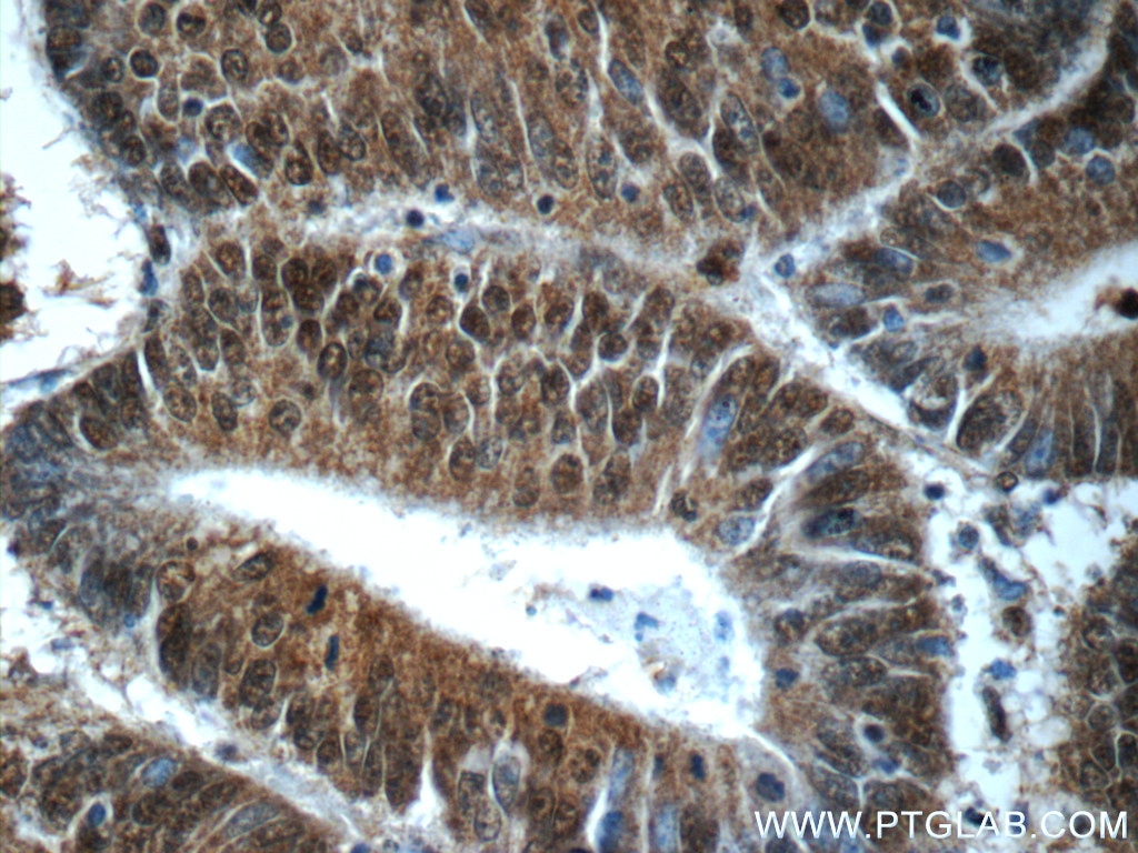 Immunohistochemistry (IHC) staining of human colon cancer tissue using HDAC10 Polyclonal antibody (24913-1-AP)