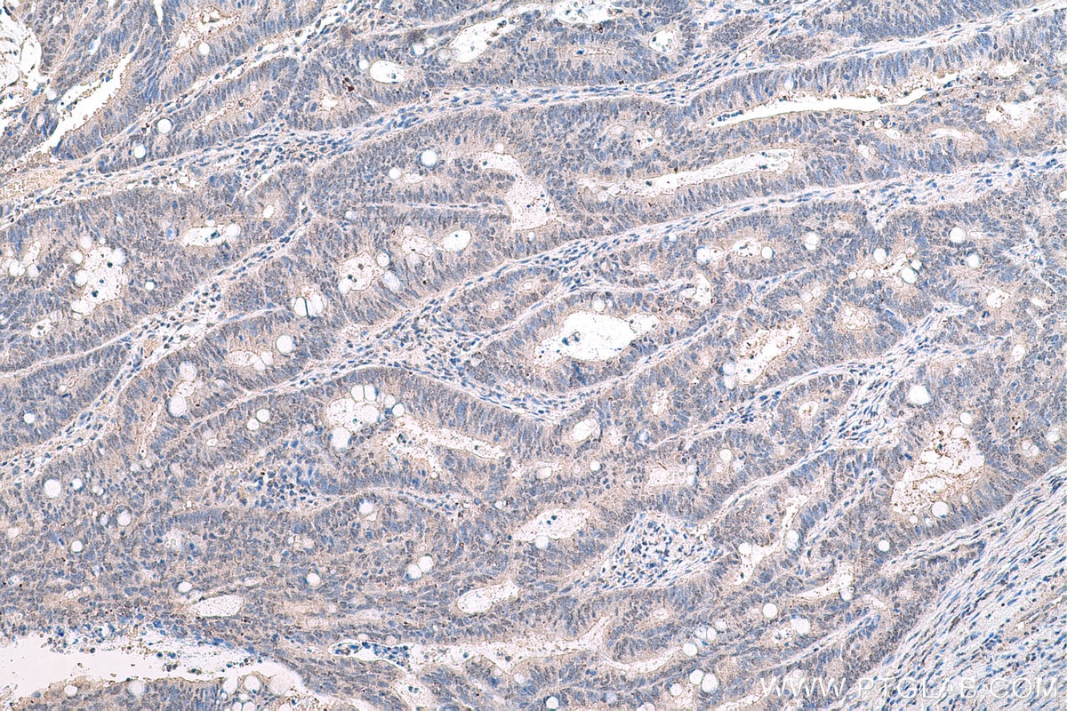Immunohistochemistry (IHC) staining of human colon cancer tissue using HDAC11 Monoclonal antibody (67949-1-Ig)