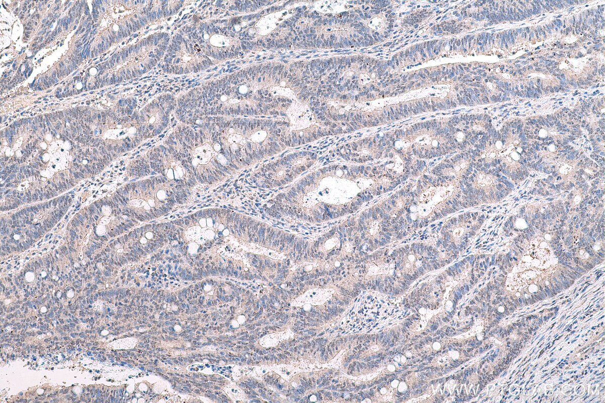 IHC staining of human colon cancer using 67949-1-Ig