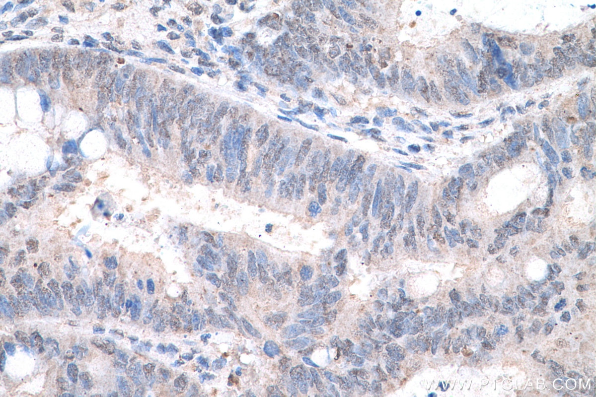 Immunohistochemistry (IHC) staining of human colon cancer tissue using HDAC11 Monoclonal antibody (67949-1-Ig)