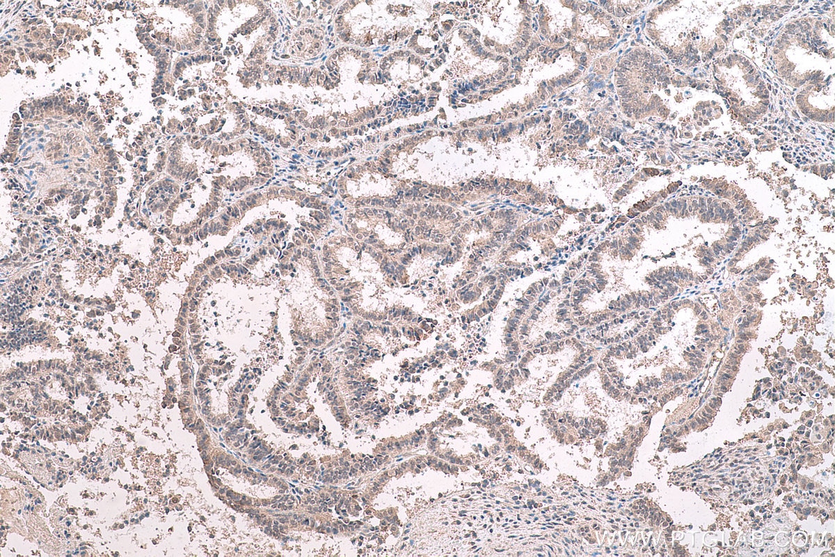 Immunohistochemistry (IHC) staining of human ovary tumor tissue using HDAC11 Monoclonal antibody (67949-1-Ig)