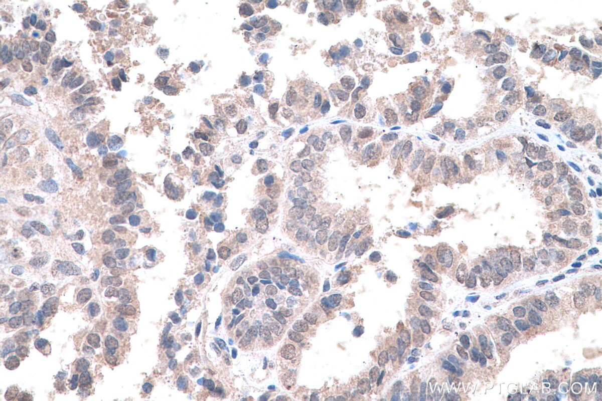 Immunohistochemistry (IHC) staining of human ovary tumor tissue using HDAC11 Monoclonal antibody (67949-1-Ig)