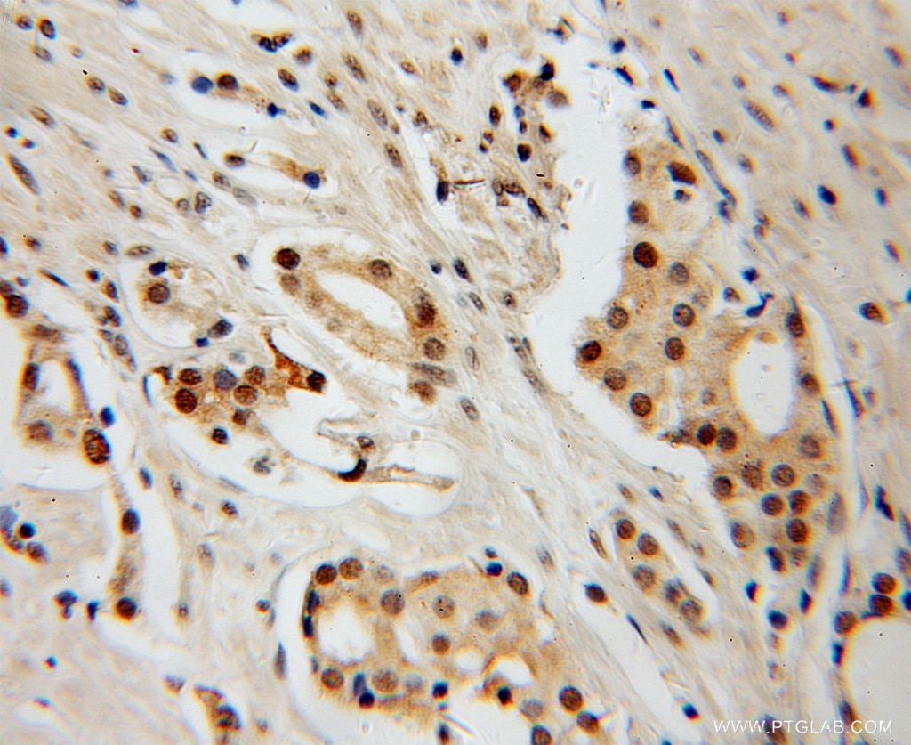 IHC staining of human prostate cancer using 12922-3-AP