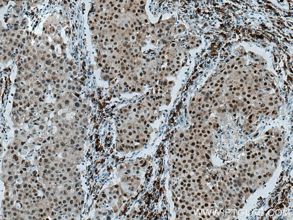 IHC staining of human breast cancer using 67165-1-Ig