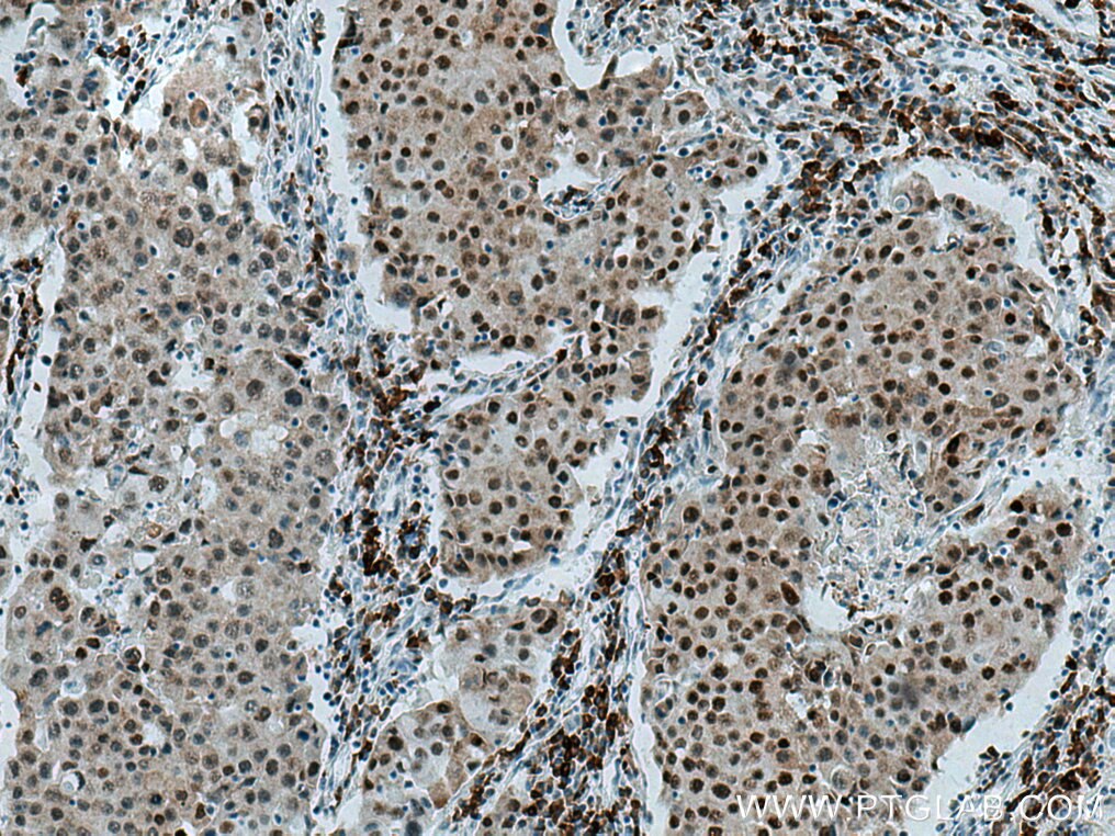 Immunohistochemistry (IHC) staining of human breast cancer tissue using HDAC2 Monoclonal antibody (67165-1-Ig)