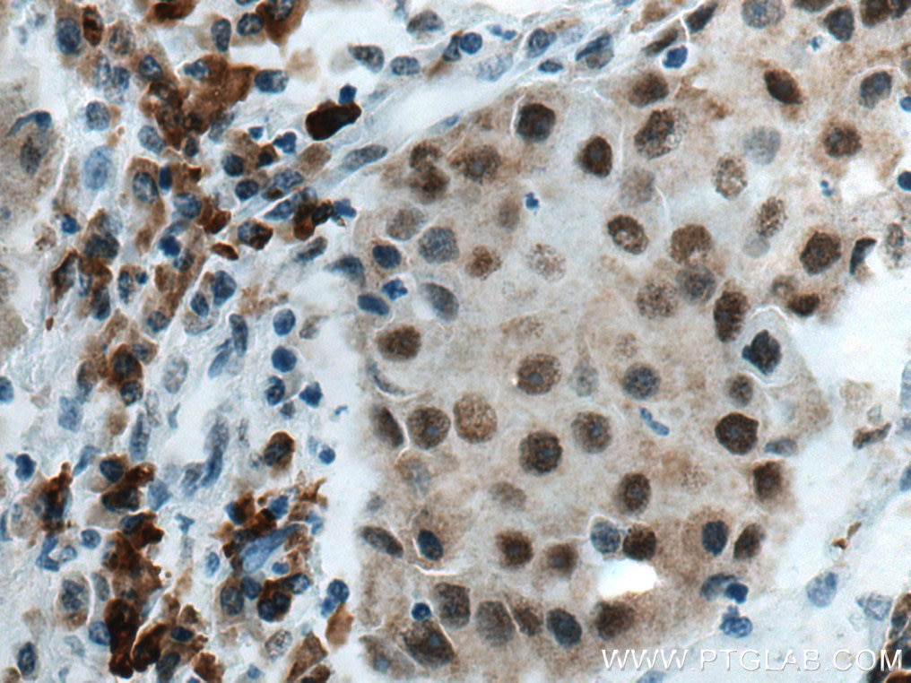 Immunohistochemistry (IHC) staining of human breast cancer tissue using HDAC2 Monoclonal antibody (67165-1-Ig)