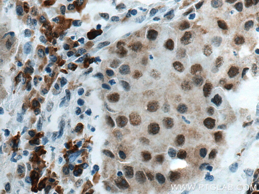 IHC staining of human breast cancer using 67165-1-Ig