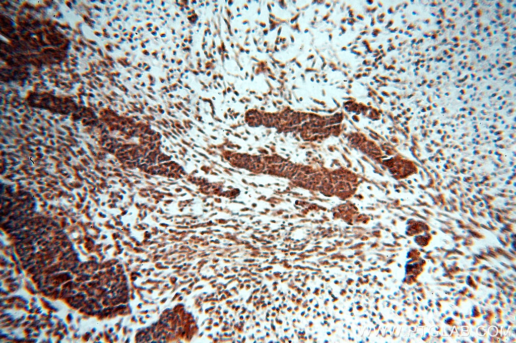 IHC staining of human ovary tumor using 10255-1-AP