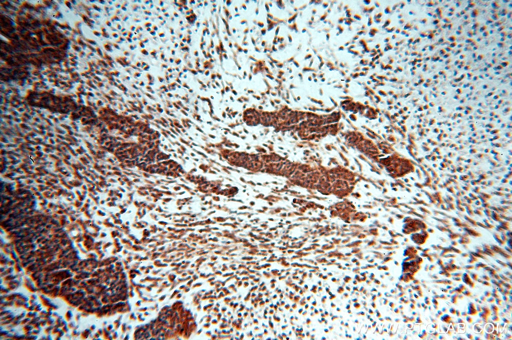 Immunohistochemistry (IHC) staining of human ovary tumor tissue using HDAC3 Polyclonal antibody (10255-1-AP)