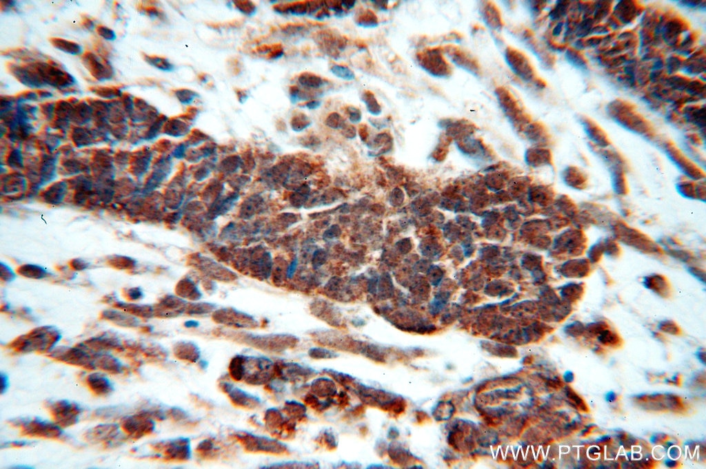 IHC staining of human ovary tumor using 10255-1-AP