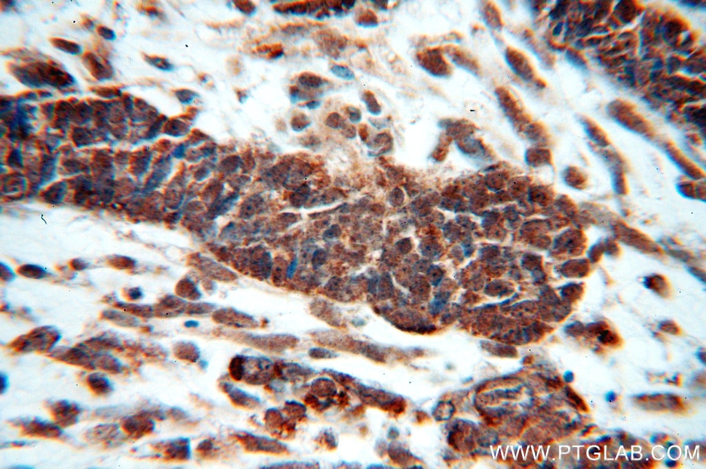 Immunohistochemistry (IHC) staining of human ovary tumor tissue using HDAC3 Polyclonal antibody (10255-1-AP)