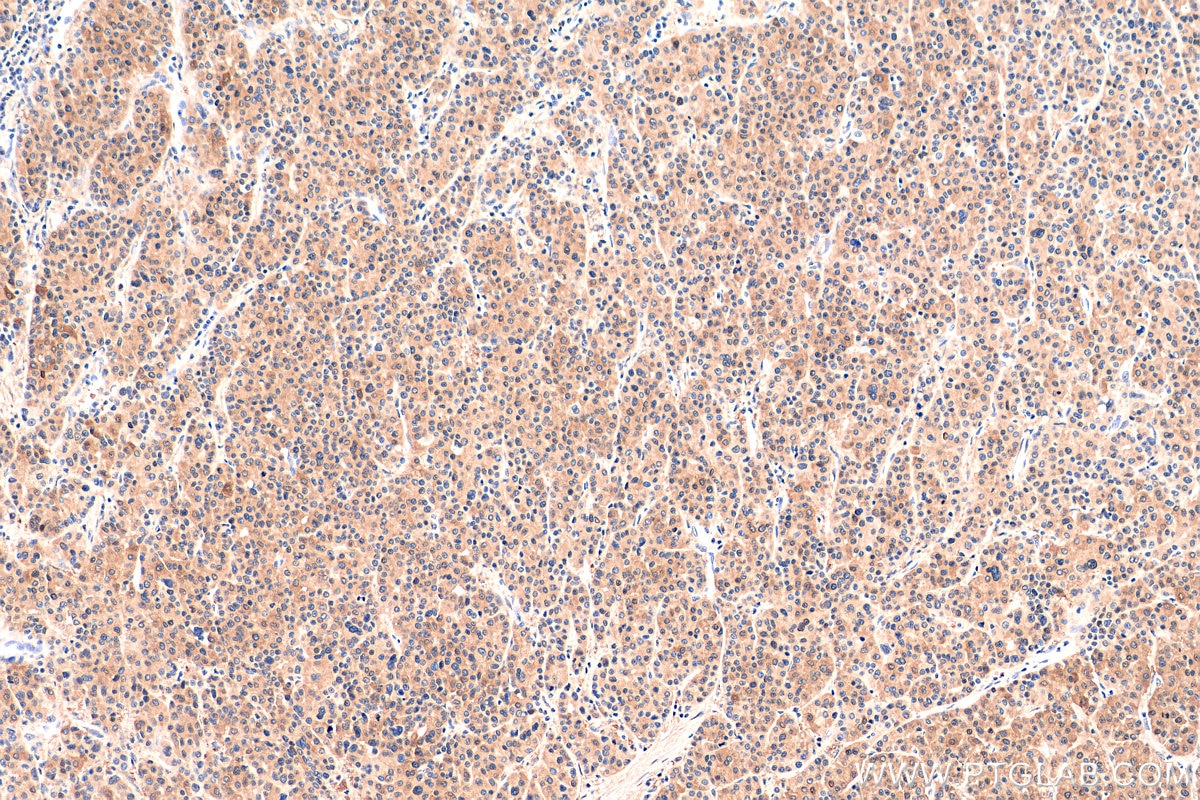 Immunohistochemistry (IHC) staining of human liver cancer tissue using HDAC3 Recombinant antibody (81211-1-RR)