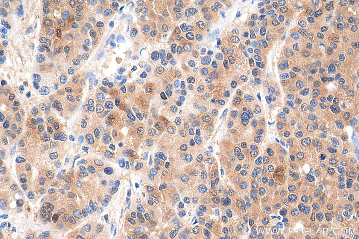 Immunohistochemistry (IHC) staining of human liver cancer tissue using HDAC3 Recombinant antibody (81211-1-RR)