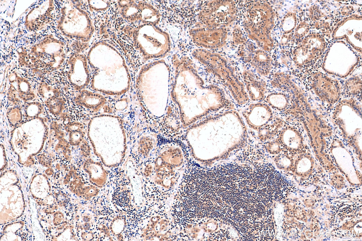 Immunohistochemistry (IHC) staining of human thyroid cancer tissue using HDAC3 Recombinant antibody (81211-1-RR)