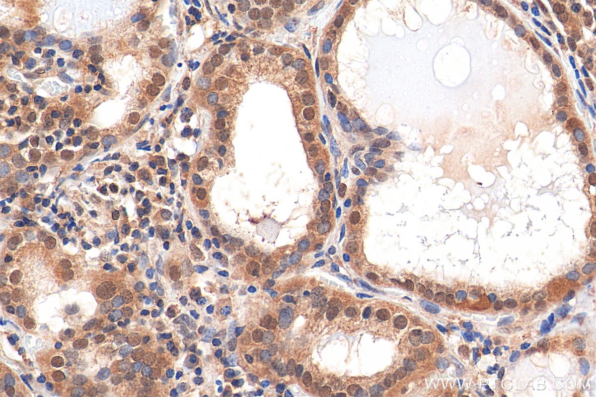 Immunohistochemistry (IHC) staining of human thyroid cancer tissue using HDAC3 Recombinant antibody (81211-1-RR)