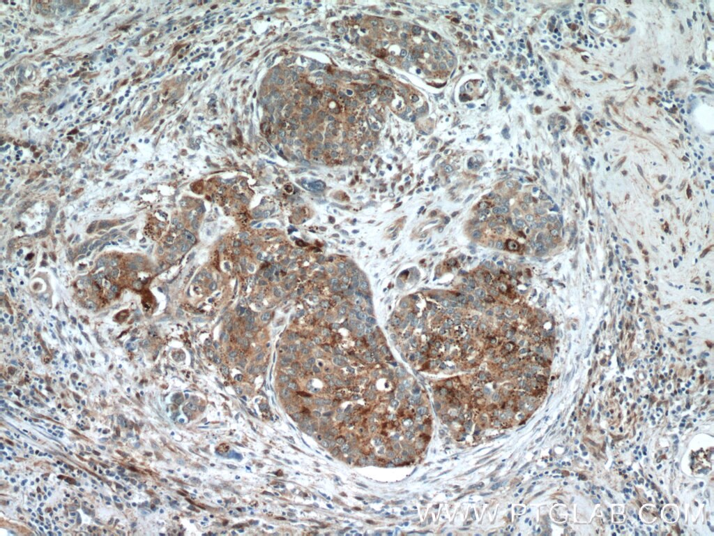 IHC staining of human cervical cancer using 17449-1-AP