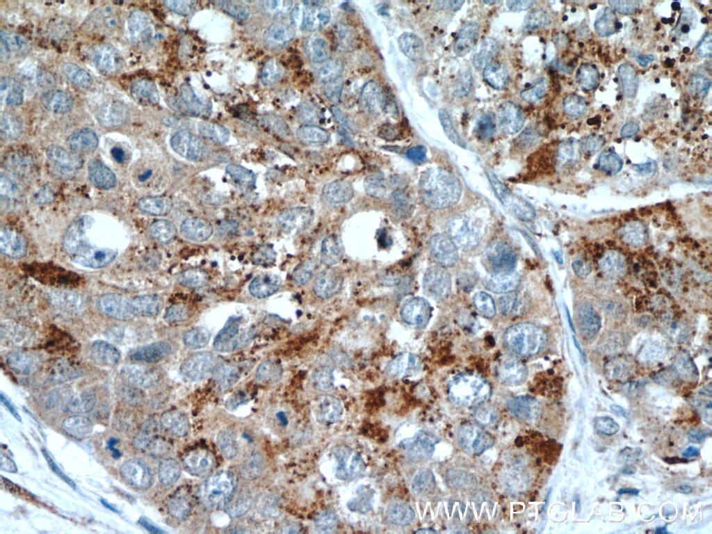 Immunohistochemistry (IHC) staining of human cervical cancer tissue using HDAC4 Polyclonal antibody (17449-1-AP)