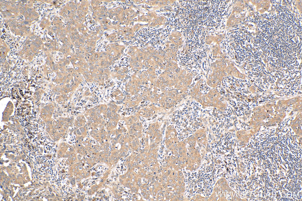 Immunohistochemistry (IHC) staining of human lung cancer tissue using HDAC4 Polyclonal antibody (29252-1-AP)