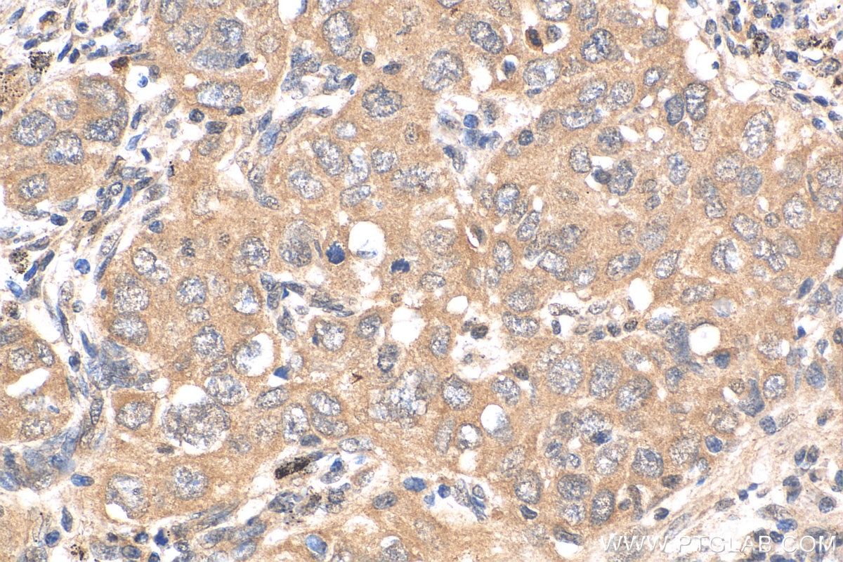 Immunohistochemistry (IHC) staining of human lung cancer tissue using HDAC4 Polyclonal antibody (29252-1-AP)