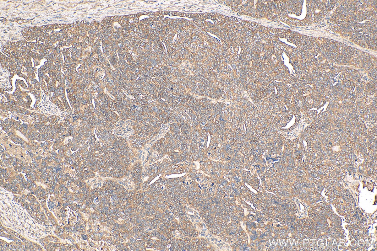 Immunohistochemistry (IHC) staining of human ovary tumor tissue using HDAC4 Polyclonal antibody (29252-1-AP)