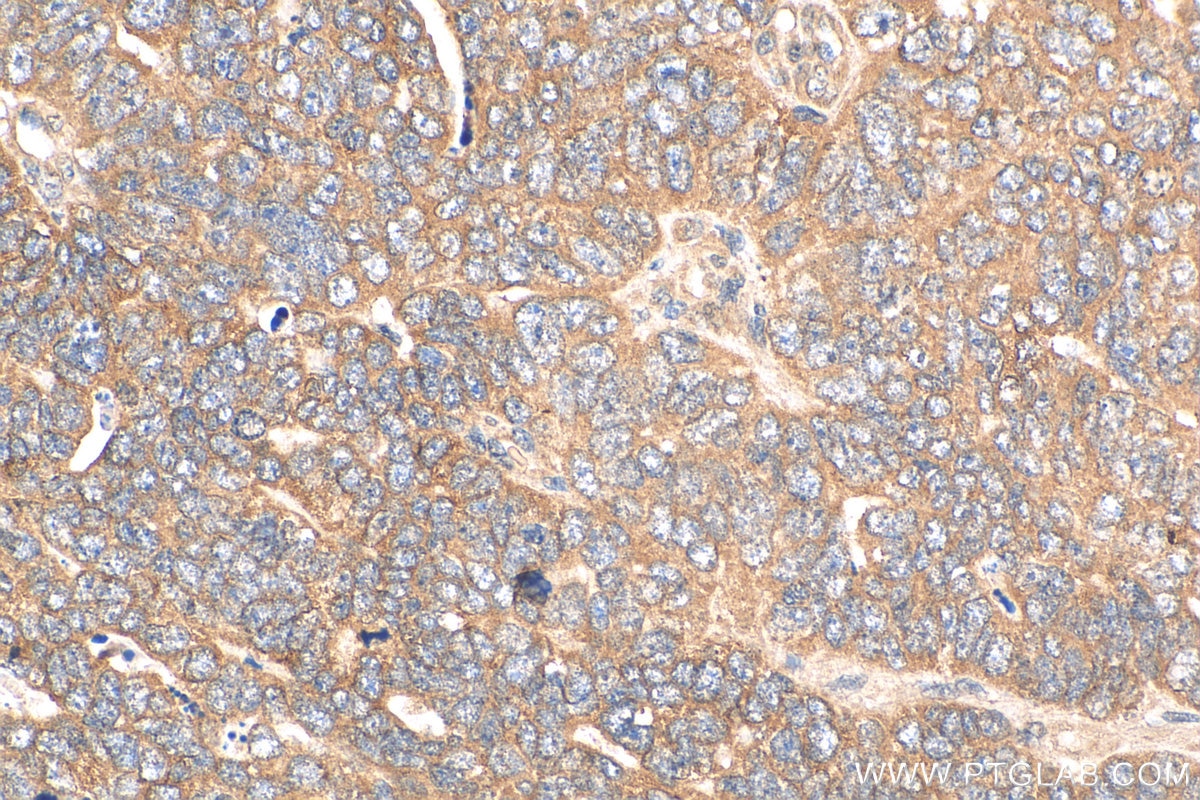Immunohistochemistry (IHC) staining of human ovary tumor tissue using HDAC4 Polyclonal antibody (29252-1-AP)