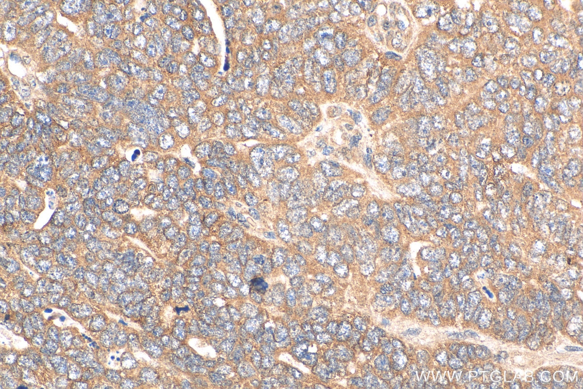 IHC staining of human ovary tumor using 29252-1-AP