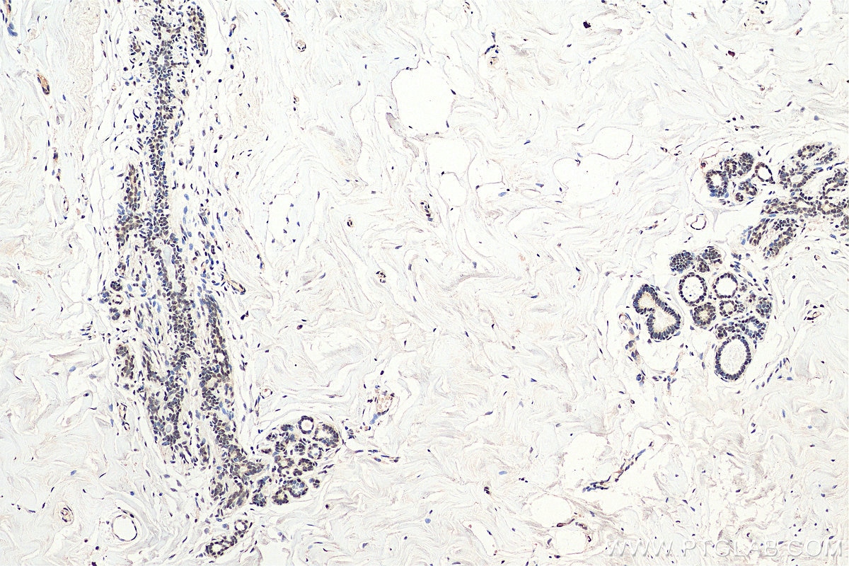 Immunohistochemistry (IHC) staining of human breast cancer tissue using HDAC4 Monoclonal antibody (66838-1-Ig)
