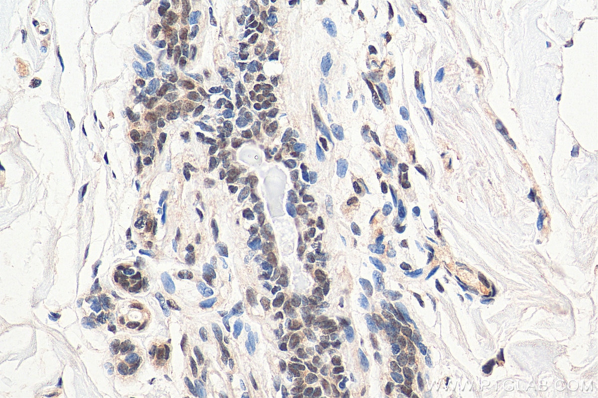 IHC staining of human breast cancer using 66838-1-Ig