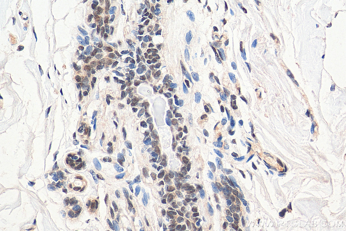 Immunohistochemistry (IHC) staining of human breast cancer tissue using HDAC4 Monoclonal antibody (66838-1-Ig)