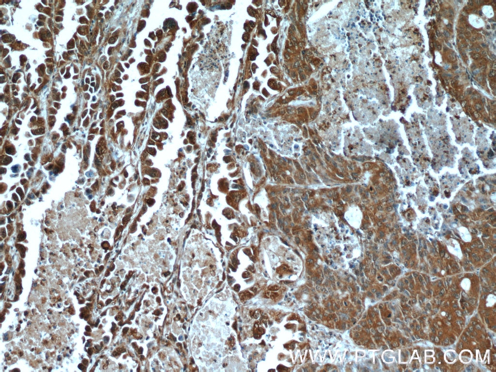 Immunohistochemistry (IHC) staining of human lung cancer tissue using HDAC4-specific Polyclonal antibody (16165-1-AP)