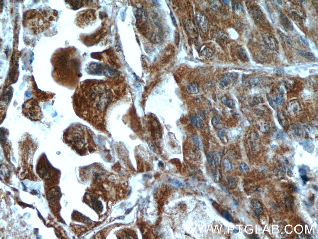 IHC staining of human lung cancer using 16165-1-AP