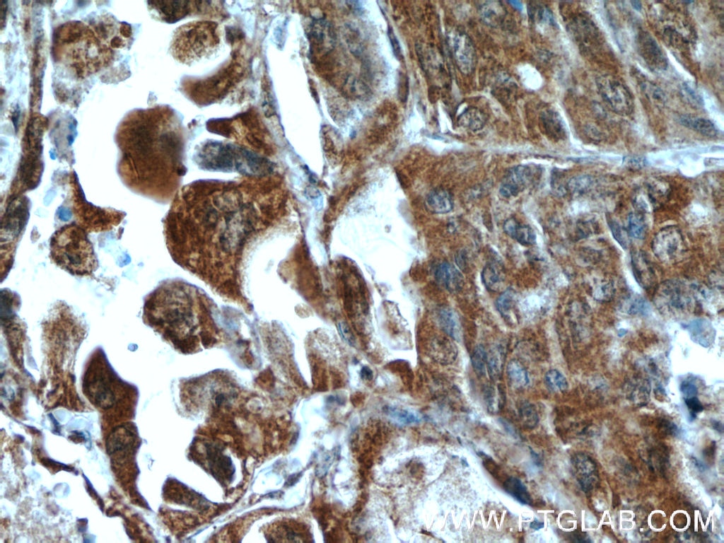 Immunohistochemistry (IHC) staining of human lung cancer tissue using HDAC4-specific Polyclonal antibody (16165-1-AP)