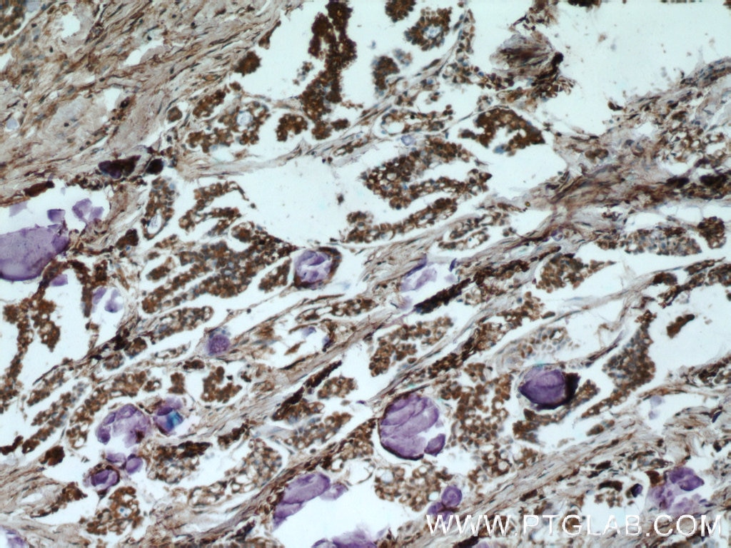 IHC staining of human ovary tumor using 16165-1-AP