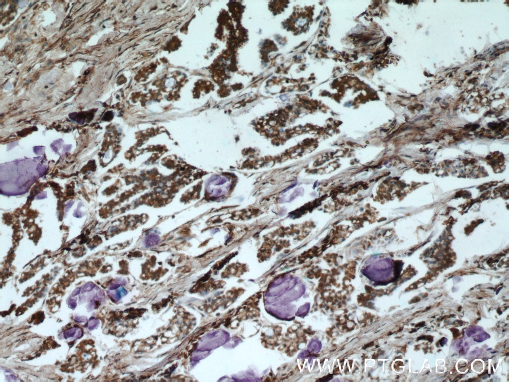 Immunohistochemistry (IHC) staining of human ovary tumor tissue using HDAC4-specific Polyclonal antibody (16165-1-AP)