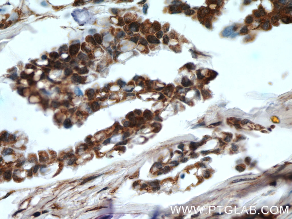 Immunohistochemistry (IHC) staining of human ovary tumor tissue using HDAC4-specific Polyclonal antibody (16165-1-AP)