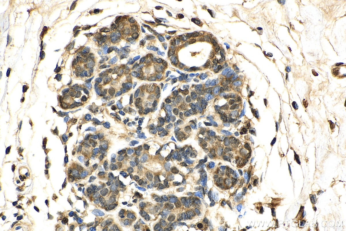 Immunohistochemistry (IHC) staining of human breast cancer tissue using HDAC6 Polyclonal antibody (12834-1-AP)