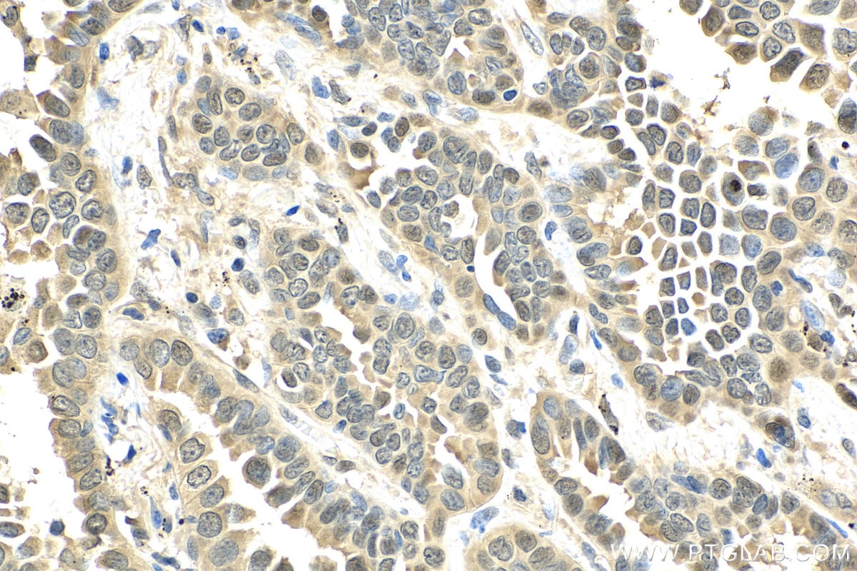 IHC staining of human lung cancer using 12834-1-AP