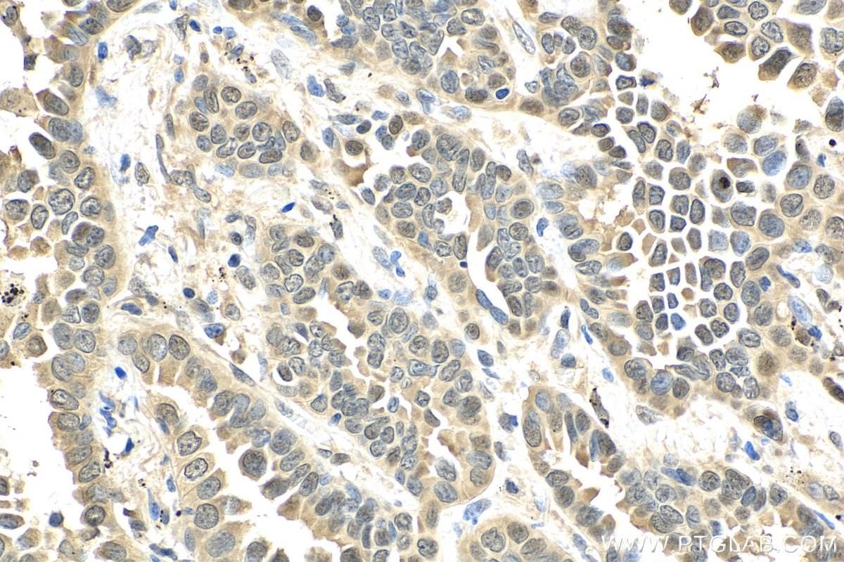 Immunohistochemistry (IHC) staining of human lung cancer tissue using HDAC6 Polyclonal antibody (12834-1-AP)