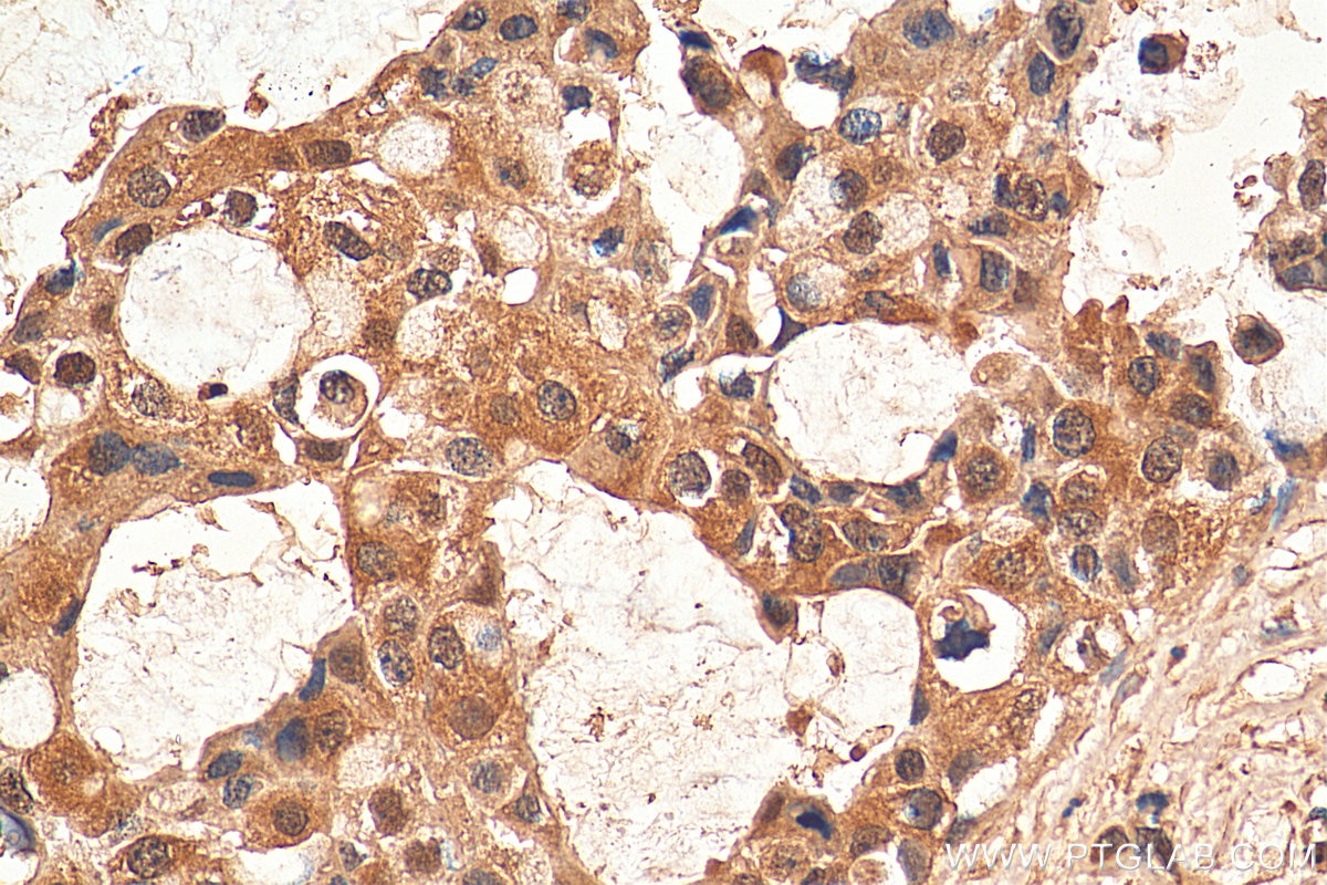 Immunohistochemistry (IHC) staining of human breast cancer tissue using HDAC6 Monoclonal antibody (67250-1-Ig)