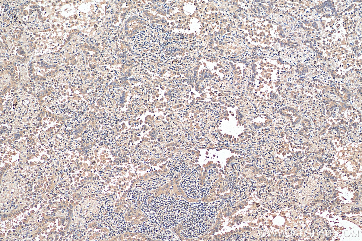 Immunohistochemistry (IHC) staining of human lung cancer tissue using HDAC6 Monoclonal antibody (67250-1-Ig)