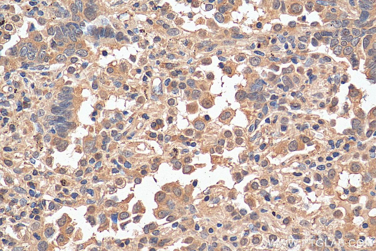Immunohistochemistry (IHC) staining of human lung cancer tissue using HDAC6 Monoclonal antibody (67250-1-Ig)