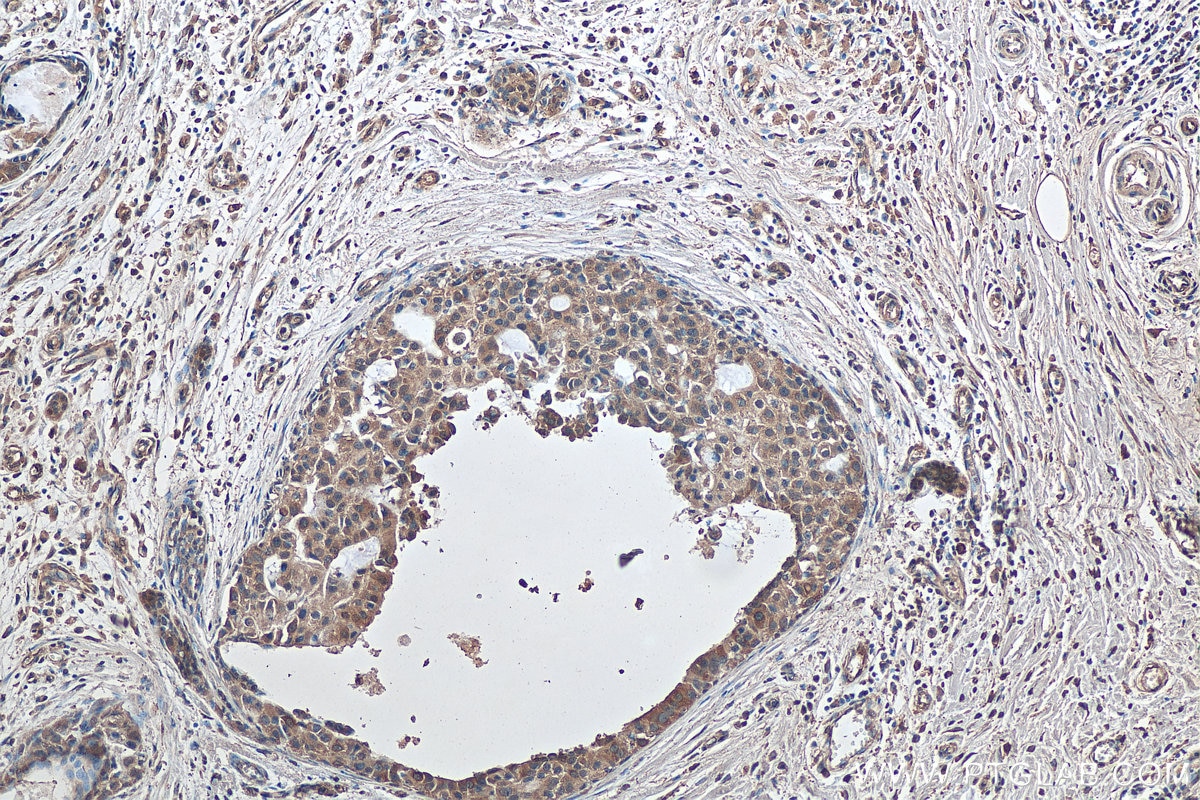 Immunohistochemistry (IHC) staining of human breast cancer tissue using HDAC6 Monoclonal antibody (67250-1-Ig)
